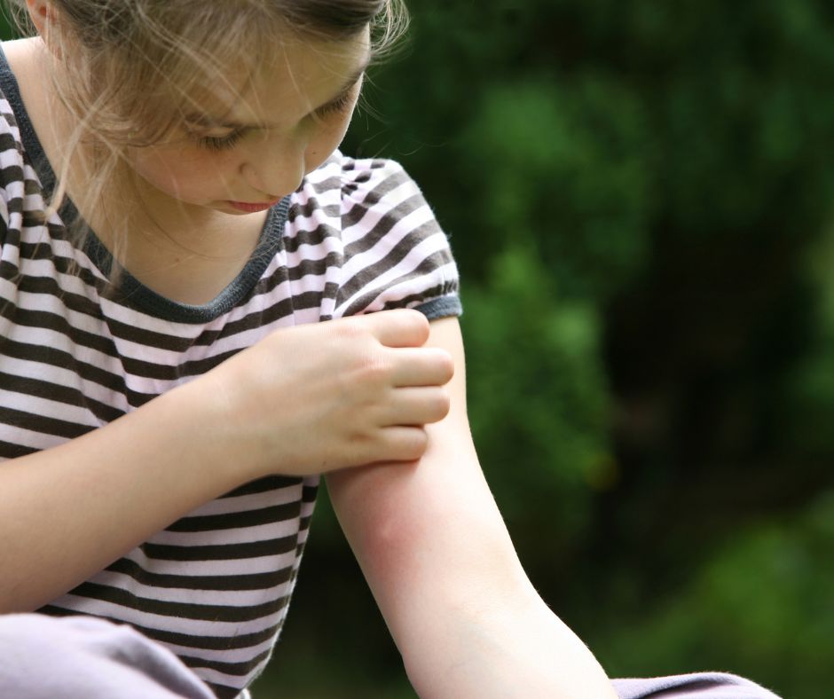 A child scratching mosquito bites.